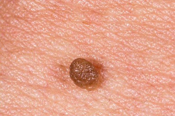 HPV Genital Siğil